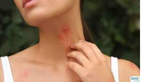 Infected insect bites advice