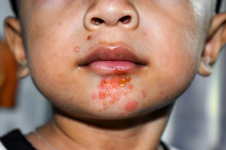 Impetigo support